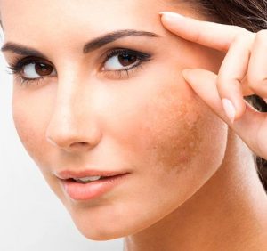 Natural-medicine-for-black-marks-on-face