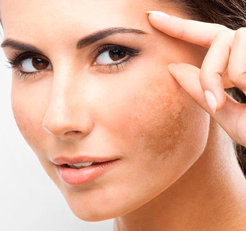 Natural-medicine-for-black-marks-on-face