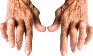 Integrative-medicine-for-rheumatoid-arthritis