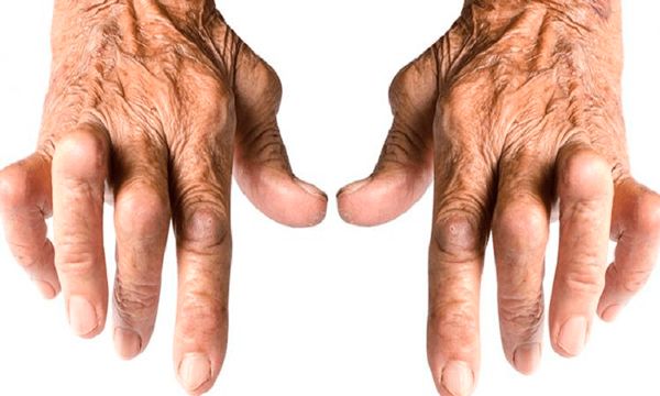 Integrative-medicine-for-rheumatoid-arthritis